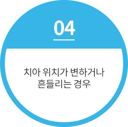 치아 위치가 변하거나 흔들리는 경우